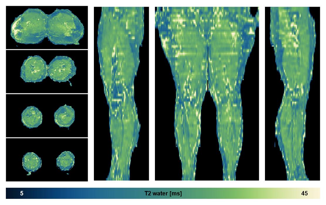 The water only T2 relaxation time of the lower extremity obtained from multi echo spin echo t2 mapping with EPG based reconstruction.